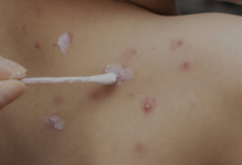 Sedes se mantiene en alerta por casos de varicela en Potosí