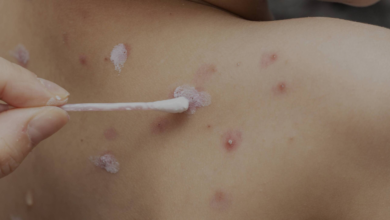 Sedes se mantiene en alerta por casos de varicela en Potosí