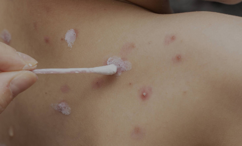Sedes se mantiene en alerta por casos de varicela en Potosí